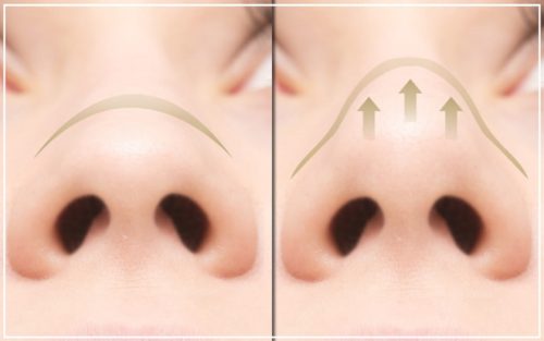 鼻尖縮小術とは 団子鼻を治す鼻先整形について詳しく解説 Mira