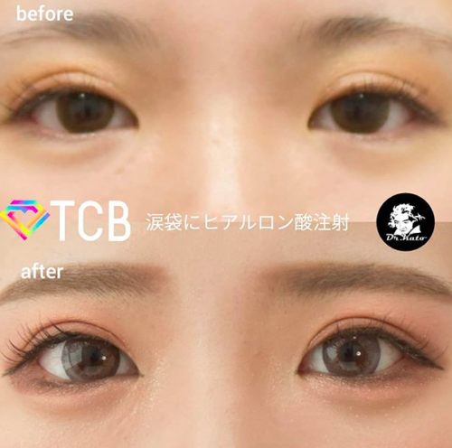 ヒアルロン酸の涙ぶくろのメリットはこれ 似合う が見つかる Mira ミラ